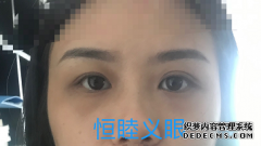 现如今高分子材料除了应用于义眼外，还应用与