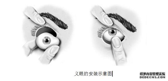 义眼的安装示意图
