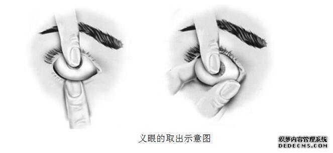 义眼的取出示意图