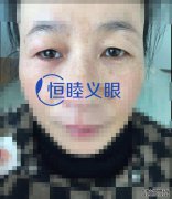 <b>义眼的作用究竟有哪些？下面为大家分析几点。</b>